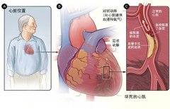 冠心病的起因是什么？