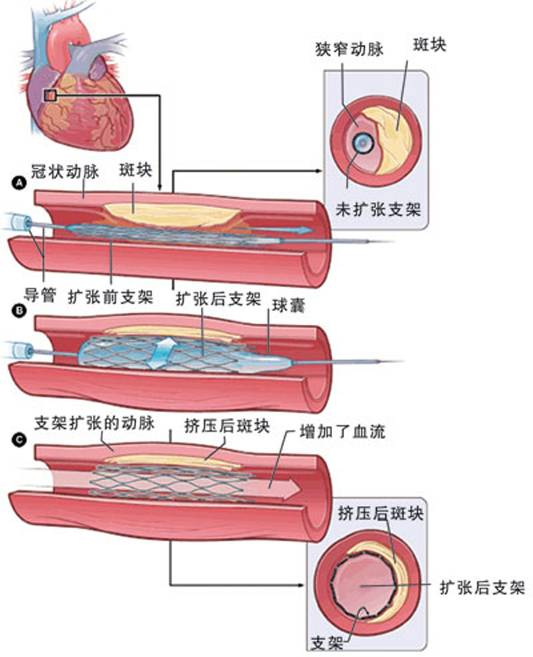 怎樣治療冠心??？(圖2)