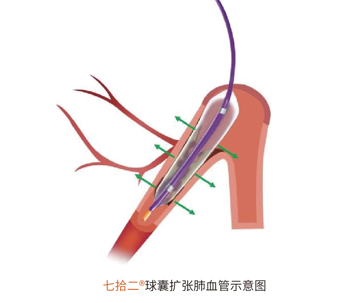 七拾二?Sev-changes 肺動脈球囊擴張導(dǎo)管(圖2)